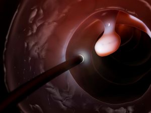 Colonoscopy